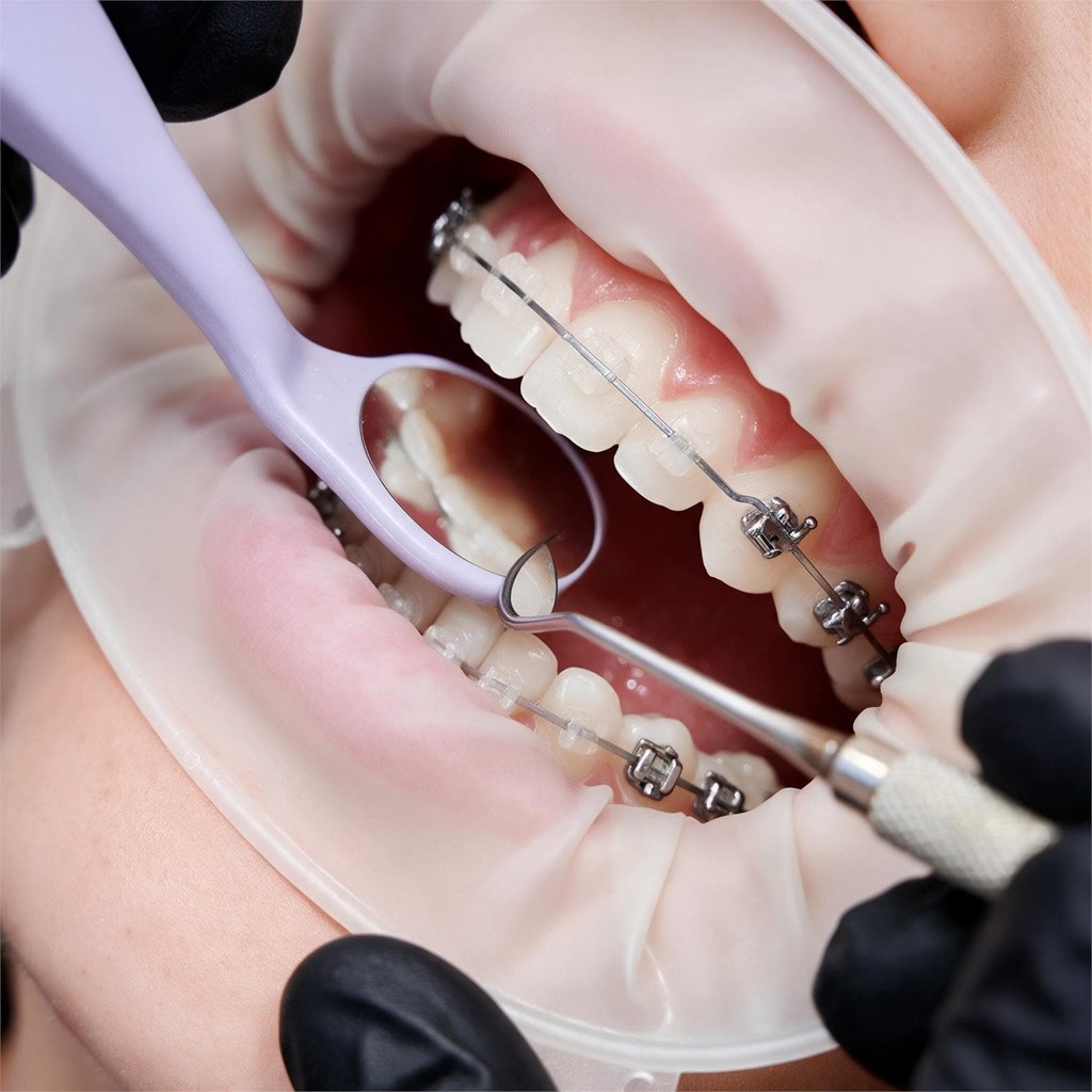 6 trucos de higiene para mantener tus brackets impecables