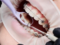 6 trucos de higiene para mantener tus brackets impecables