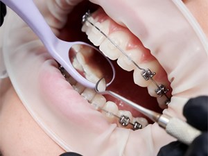 6 trucos de higiene para mantener tus brackets impecables