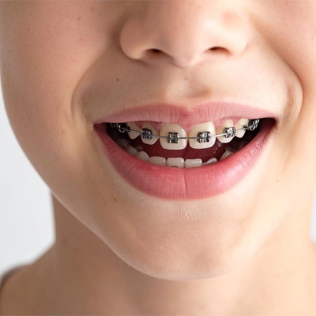 ¿A partir de qué edad se puede poner una ortodoncia?