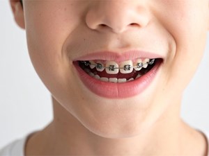 ¿A partir de qué edad se puede poner una ortodoncia?