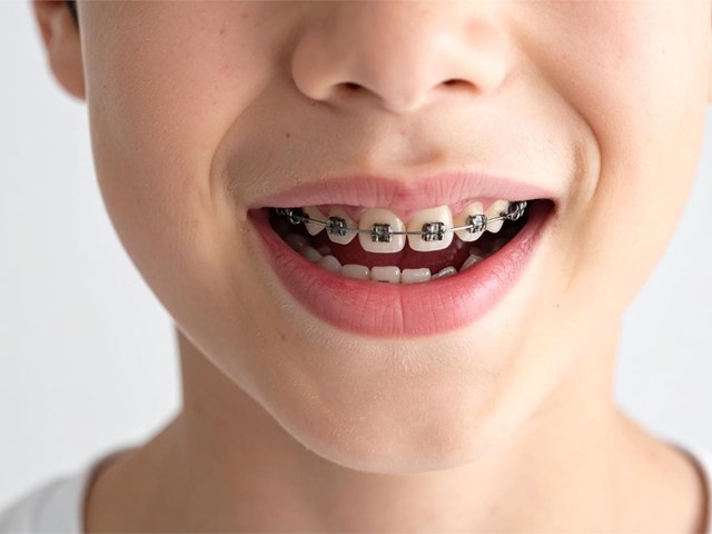 ¿A partir de qué edad se puede poner una ortodoncia?