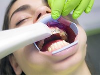 Aparatos dentales recomendados para los niños
