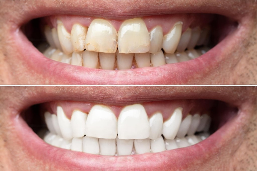 Blanqueamiento dental: falsos mitos y realidades sobre este tratamiento