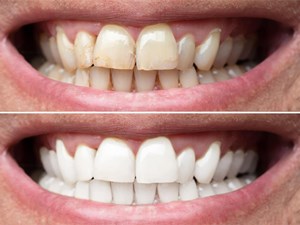 Blanqueamiento dental: falsos mitos y realidades sobre este tratamiento