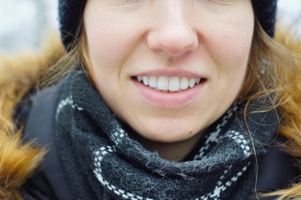 Carillas dentales: tipos y usos