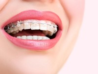 Cómo elegir el tipo de ortodoncia más adecuado para ti
