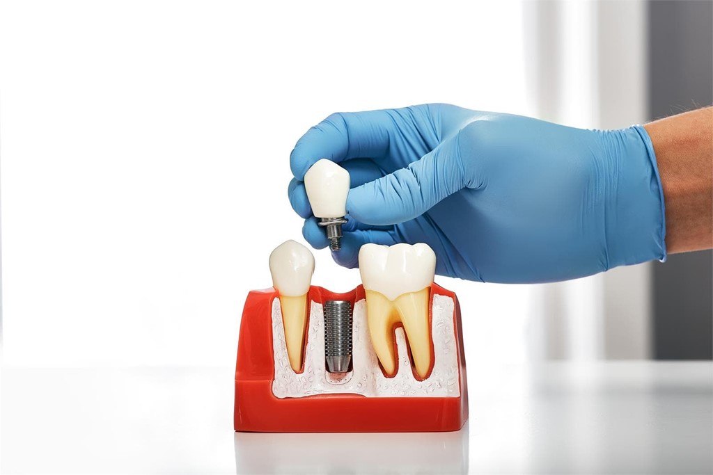 ¿Cuáles son los beneficios de los implantes dentales?