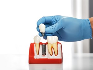 ¿Cuáles son los beneficios de los implantes dentales?