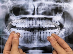 ¿Es la ortodoncia invisible la solución para mi sonrisa?