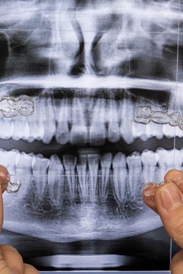 ¿Es la ortodoncia invisible la solución para mí?