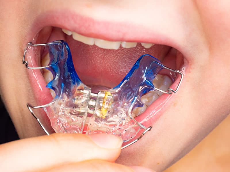 Aparato dental  en Lugo