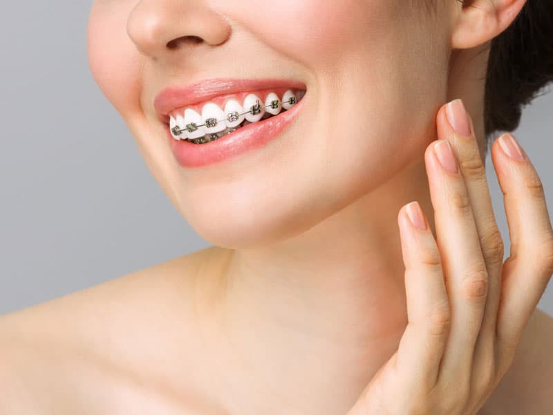 Brackets  en Lugo