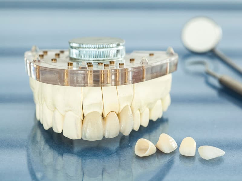 carillas de dientes en Lugo