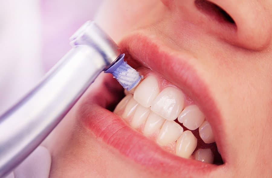 limpieza dental en Lugo
