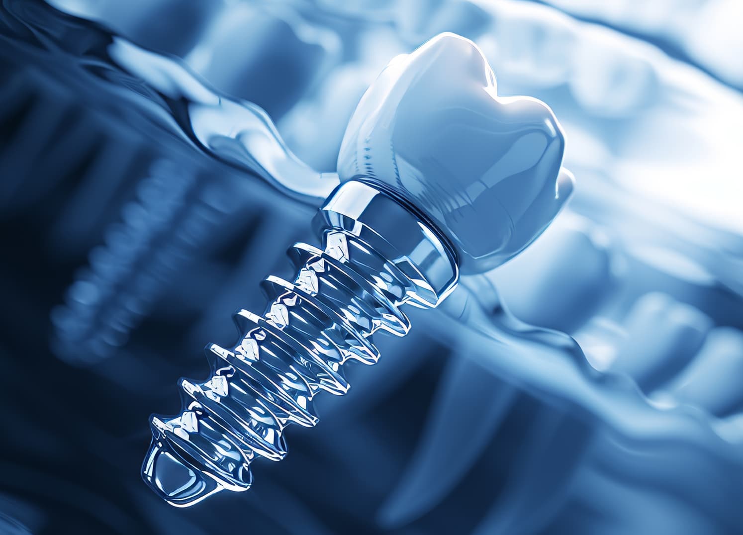 Implantes dentales en Lugo