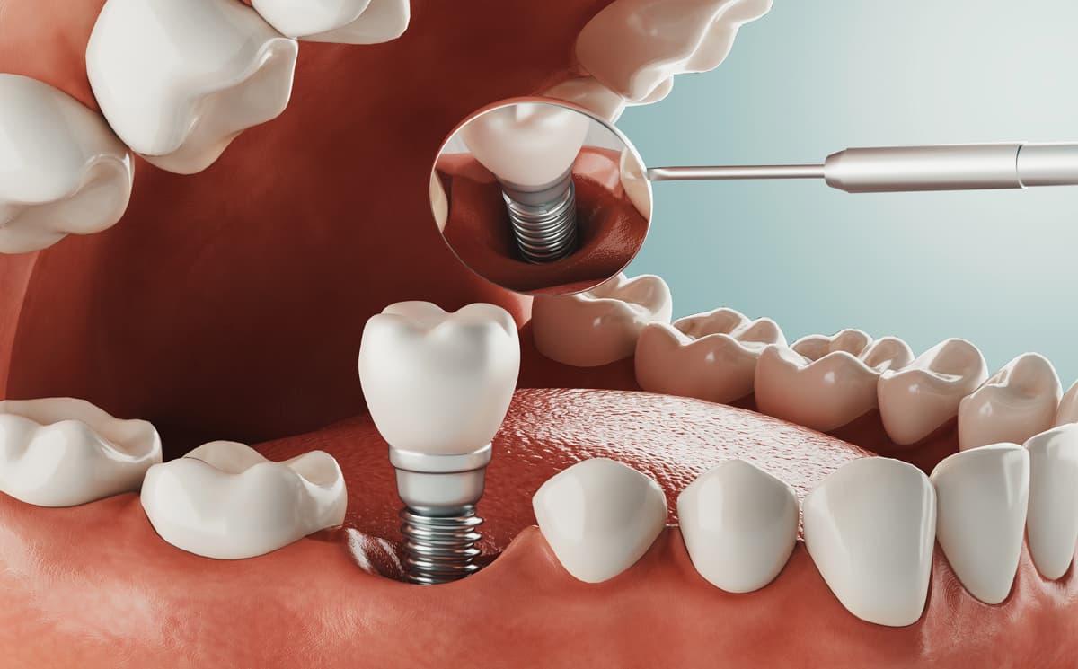 limpieza dental en Lugo