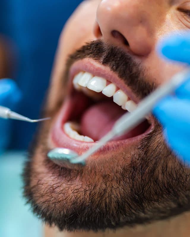 Carillas dentales en Lugo