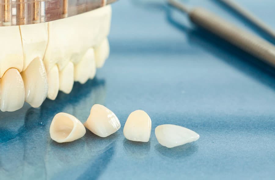 Carillas de zirconio en Lugo