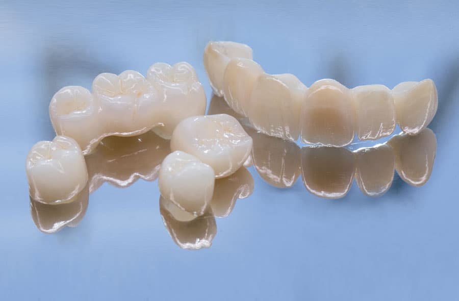 Precio carillas dentales en Lugo