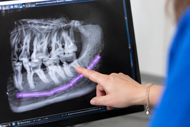 ¿Poco hueso para un implante? Regeneración ósea dental en Lugo - Imagen 1