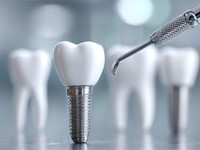 ¿Puedo comer alimentos duros si tengo implantes dentales?