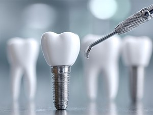 ¿Puedo comer alimentos duros si tengo implantes dentales?