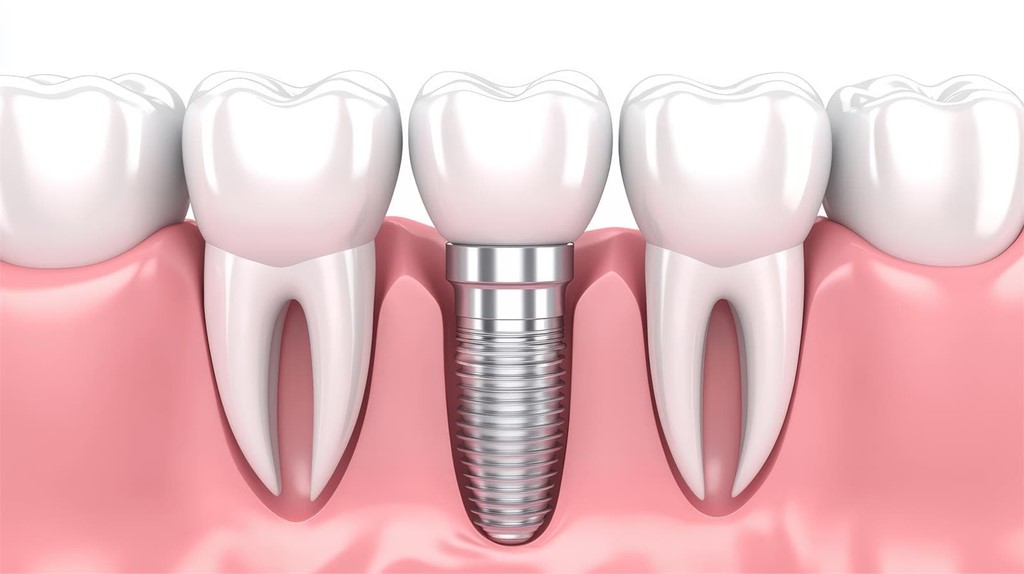 ¿Puedo hacer deporte si tengo un implante dental?