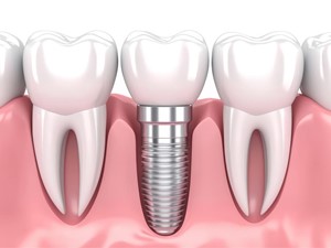 ¿Puedo hacer deporte si tengo un implante dental?