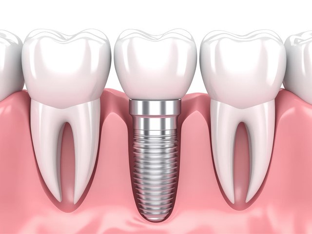 ¿Puedo hacer deporte si tengo un implante dental?