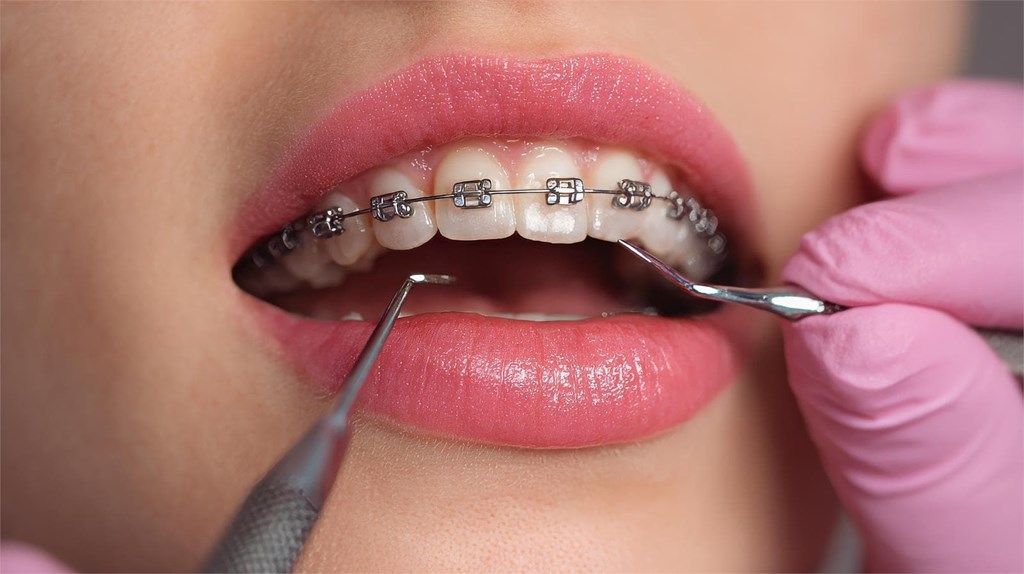 ¿Qué hacer si se te suelta un bracket?