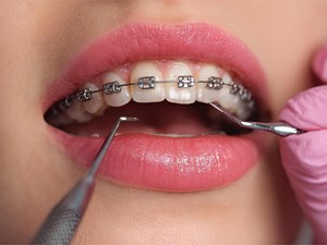 ¿Qué hacer si se te suelta un bracket?