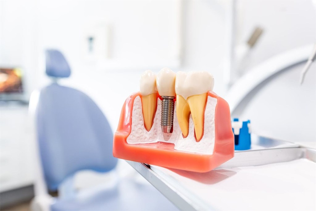 ¿Qué pasa si pierdo un diente y no pongo un implante?