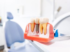 ¿Qué pasa si pierdo un diente y no pongo un implante?