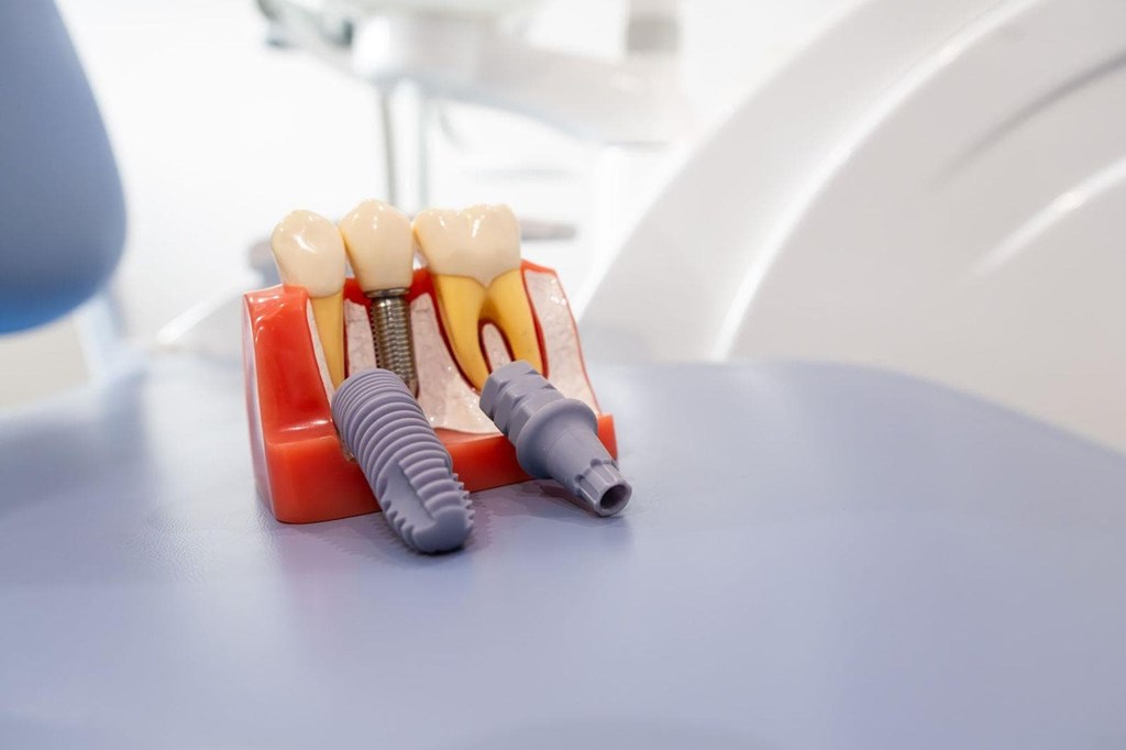 Regeneración ósea guiada: así preparamos tu boca para el futuro en nuestra clínica dental en Lugo