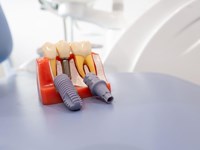 Regeneración ósea guiada: así preparamos tu boca para el futuro en nuestra clínica dental en Lugo