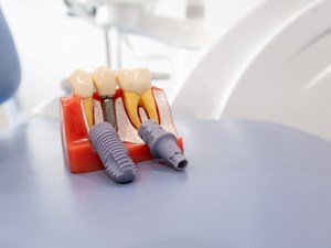 Regeneración ósea guiada: así preparamos tu boca para el futuro en nuestra clínica dental en Lugo