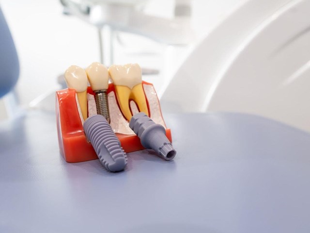 Regeneración ósea guiada: así preparamos tu boca para el futuro en nuestra clínica dental en Lugo