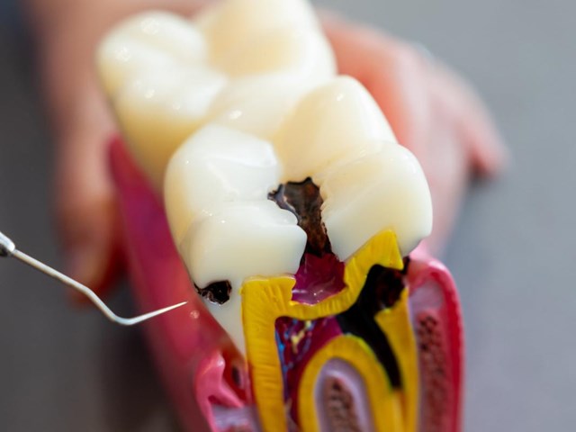 Salva tu diente con la apicectomía o cirugía radicular en Lugo