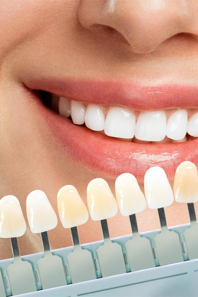 Tratamientos con coronas y carillas dentales en Lugo