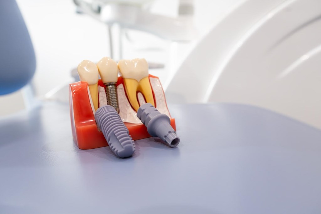 Foto 1 Vuelve a sonreír en días con los implantes dentales de carga inmediata en Lugo