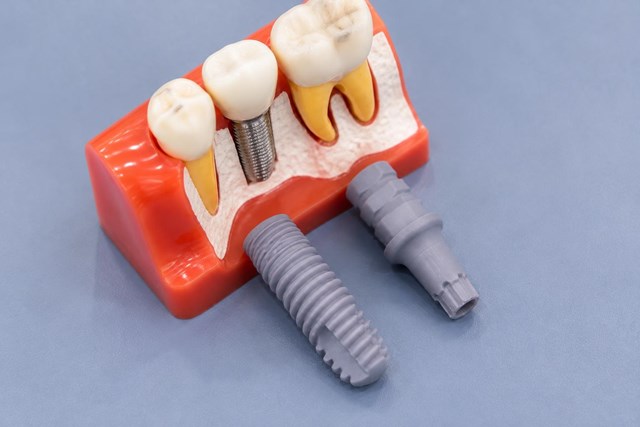 Vuelve a sonreír en días con los implantes dentales de carga inmediata en Lugo - Imagen 1