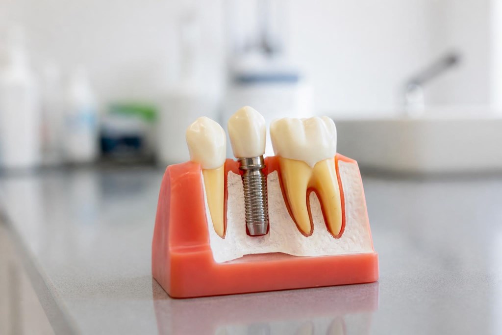 Foto 1 Vuelve a sonreír gracias a nuestros implantes dentales en Lugo