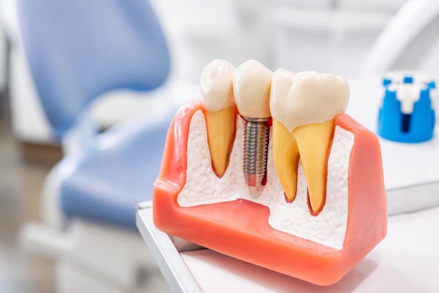 Vuelve a sonreír gracias a nuestros implantes dentales en Lugo - Imagen 1
